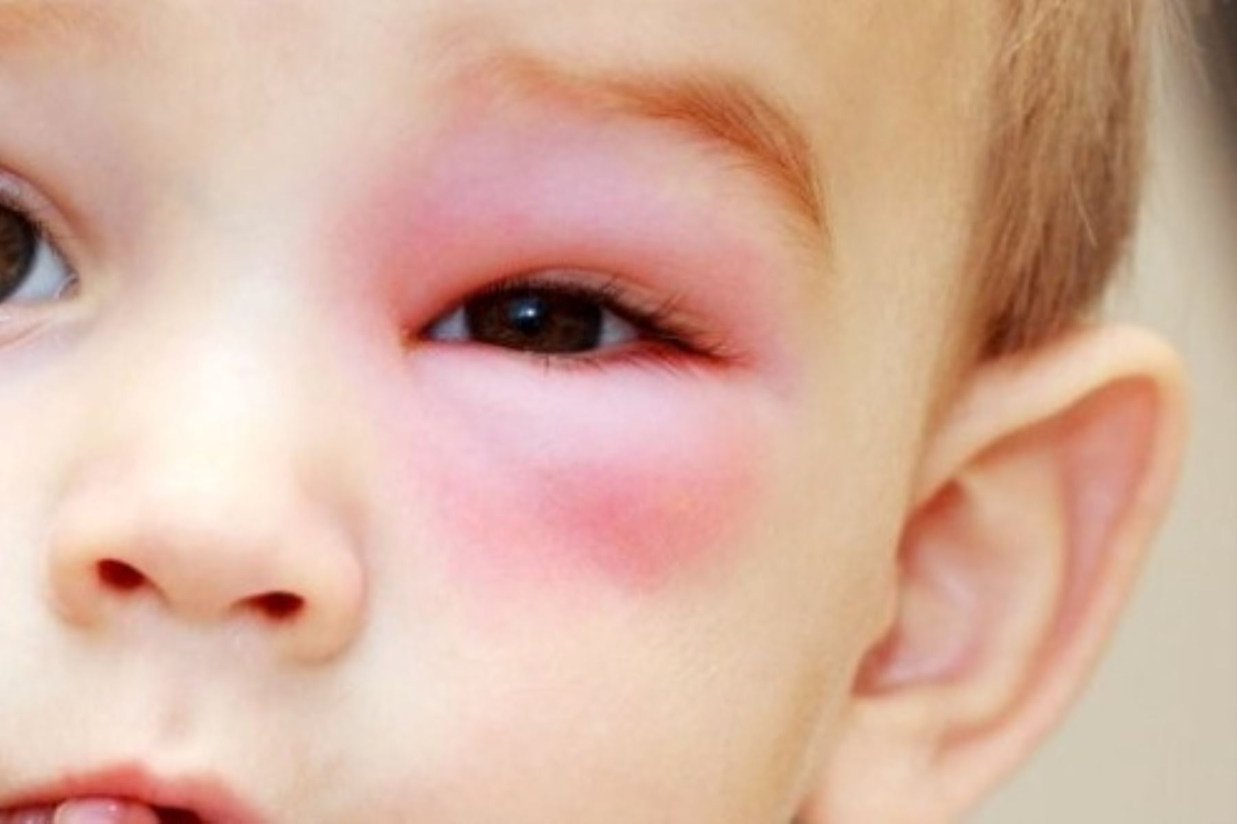 ¡Cuidado! Trauma ocular es una amenaza para la visión de los niños