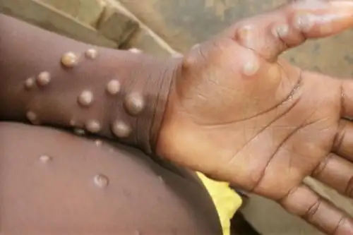 La viruela del mono es una zoonosis viral rara, es decir, una enfermedad provocada por un virus transmitido de los animales a las personas que se ha detectado, principalmente, en el África. Foto: OMS