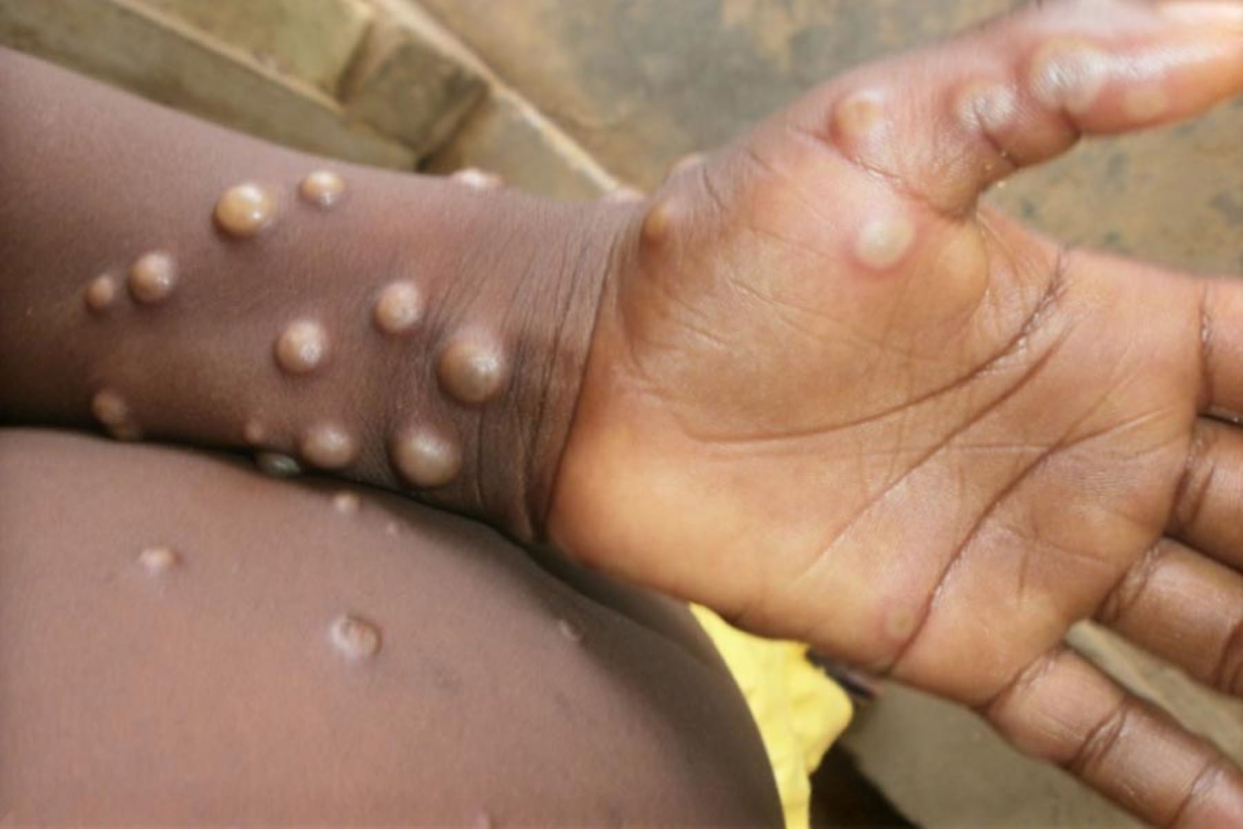 Viruela del mono: cómo se contagia esta enfermedad que genera lesiones en la piel