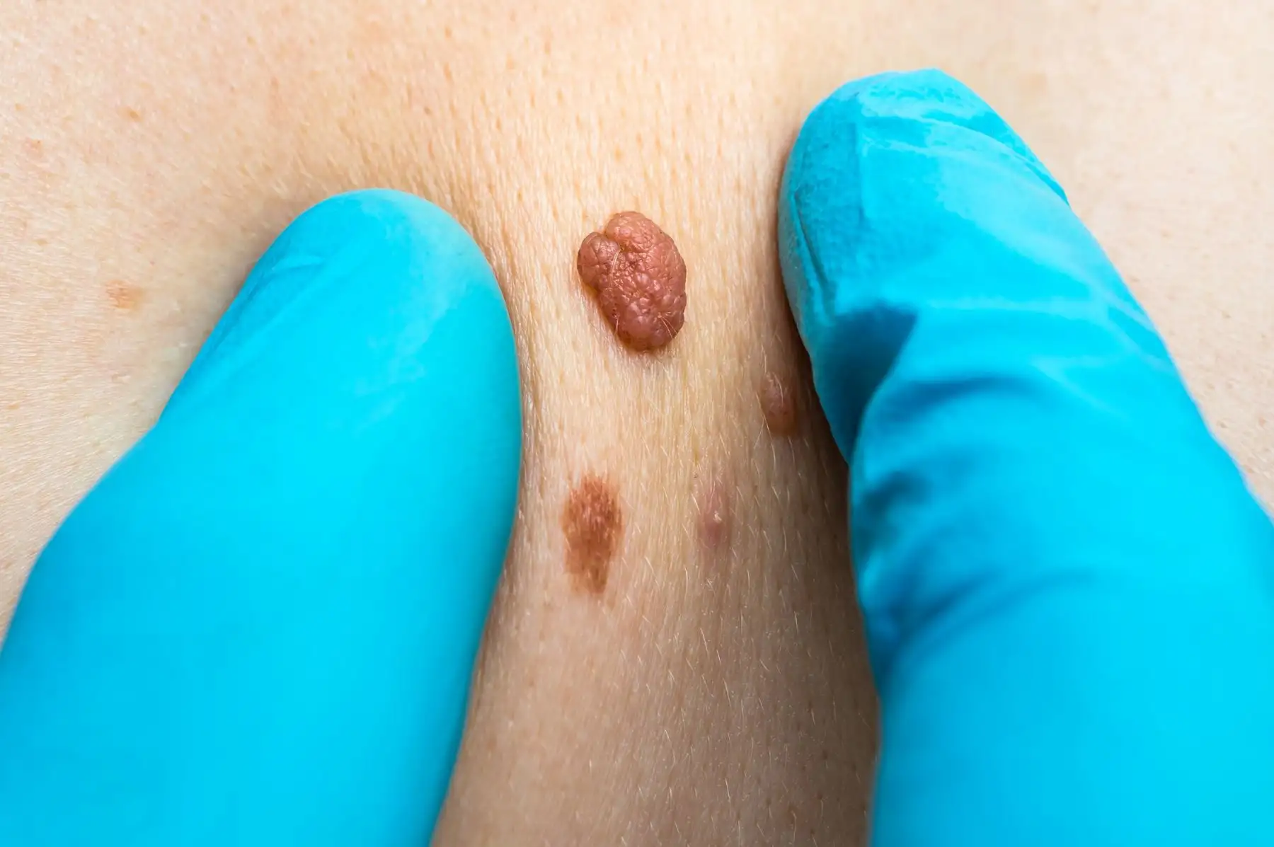 El melanoma. Foto: Liga contra el Cáncer.
