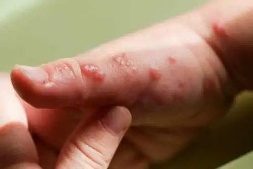 El Ministerio de Salud lanzó la alerta epidemiológica frente al avance de casos a escala mundial. INTERNET/Medios