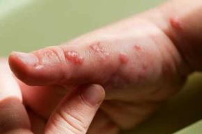 Lesiones en la piel producto de la viruela del mono . Foto: Internet