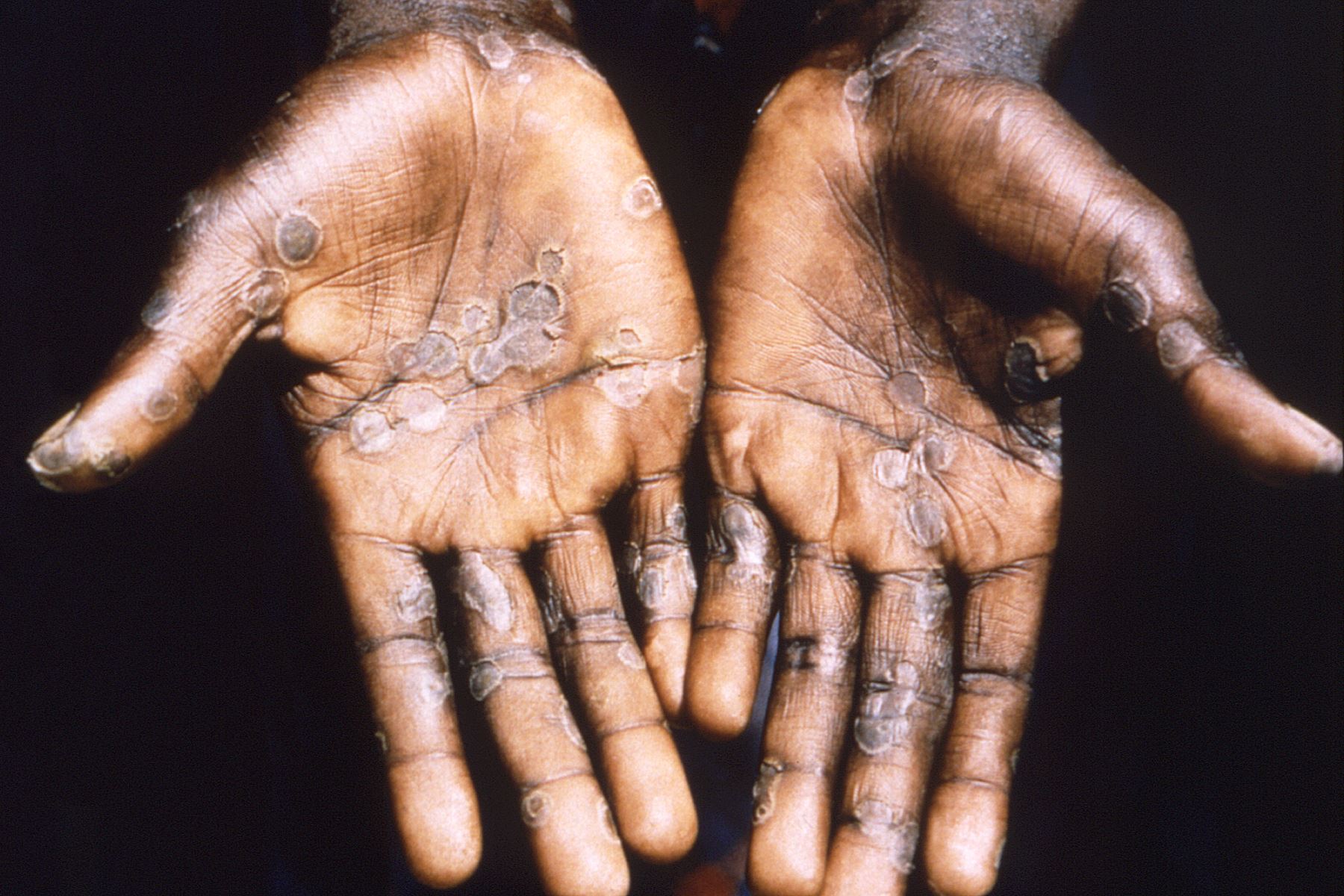 Imagen de las lesiones en la piel provocadas por la viruela del mono, durante un estudio llevado a cabo en la República Democrática del Congo entre los años 1996 y 1997. Foto: EFE