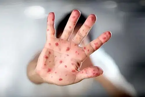 Infectólogo indica las diferencias entre la viruela del mono y la enfermedad de manos, pies y boca. Foto: Andina