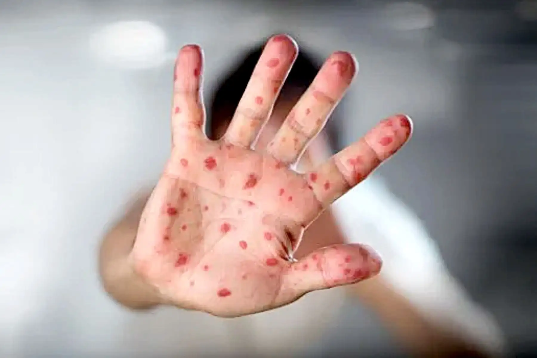 Infectólogo indica las diferencias entre la viruela del mono y la enfermedad de manos, pies y boca. Foto: Andina