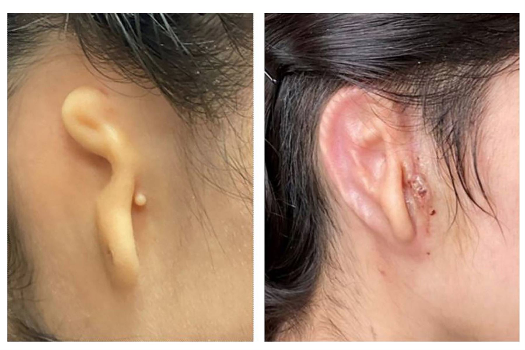Una foto sin fecha proporcionada por el Dr. Arturo Bonilla del Microtia-Congenital Ear Institute muestra a Alexa, una paciente que pidió ser identificada sólo por su nombre, antes de la cirugía, a la izquierda y 30 días después de una cirugía de implante de oreja impreso en 3D, según publicó el Chicago Tribune. Foto: Dr. Arturo Bonilla