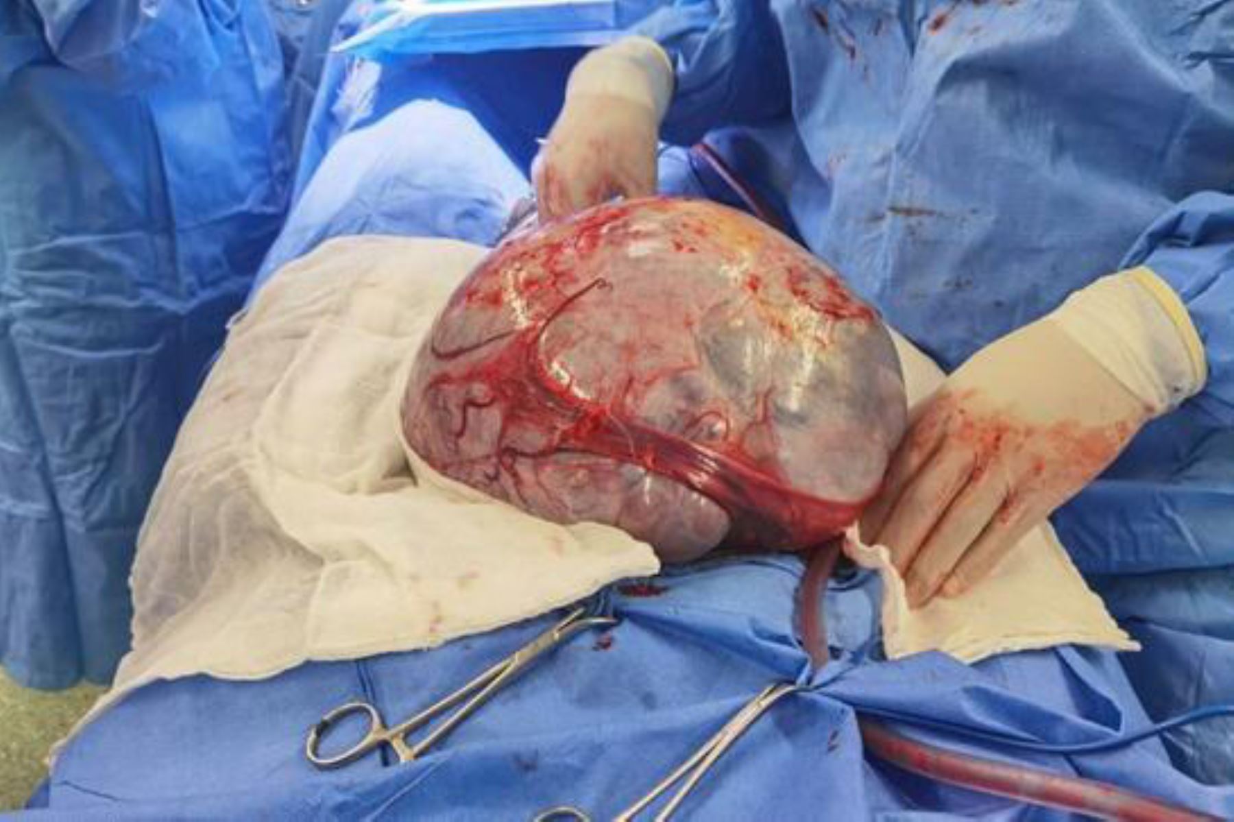 Médicos extirpan tumor de 7 kilos a madre de familia. Foto: ANDINA/Difusión