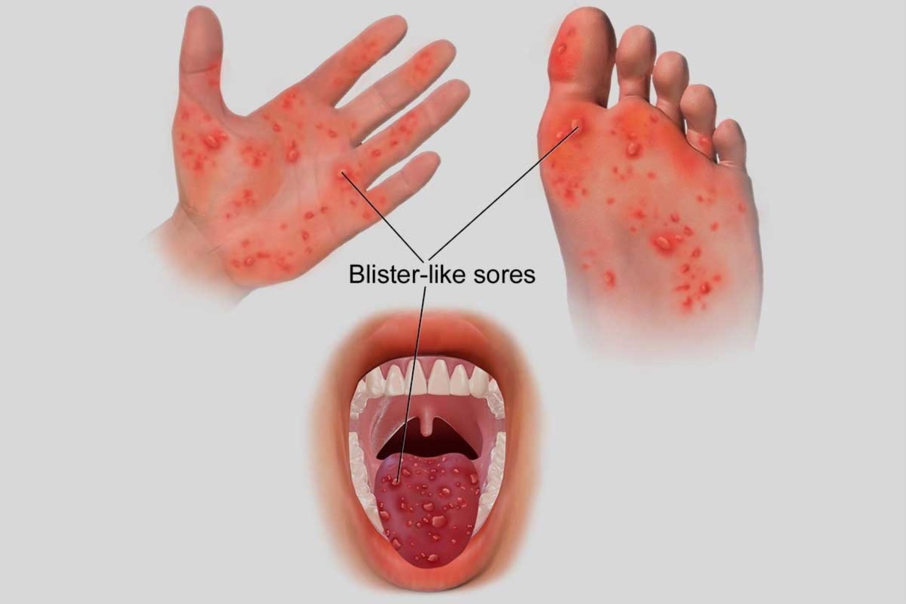 Los síntomas de la enfermedad de manos, pies y boca son dolor abdominal, malestar general, fiebre, dolor de garganta y llagas, primero en la boca, luego en manos y después en la planta de los pies.