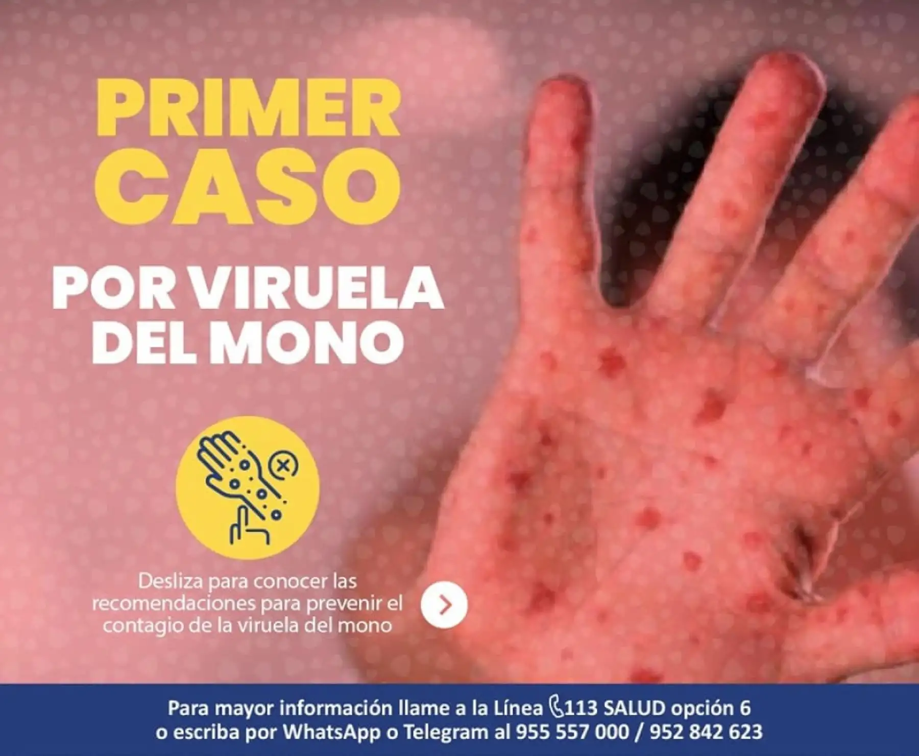 Autoridades de Salud de Loreto confirmaron el primer caso de viruela del mono en la ciudad de Iquitos. Anunciaron que implementaron un cerco epidemiológico para evitar su propagación. Foto: ANDINA/difusión.