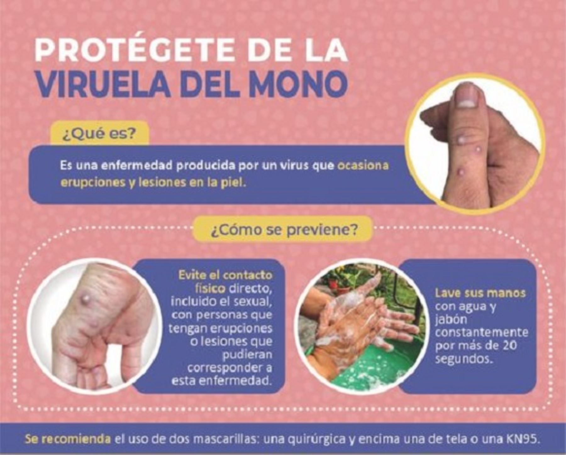 Instituto Nacional de Salud descarta casos de viruela del mono en la región Arequipa. Los tres casos sospechosos dieron negativo a la enfermedad.