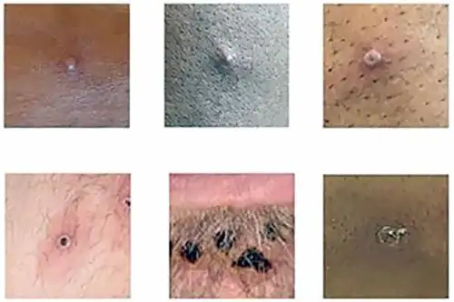 La OMS contabiliza más de 18,000 casos de viruela del mono detectados en 78 países desde mayo. Foto: AFP.