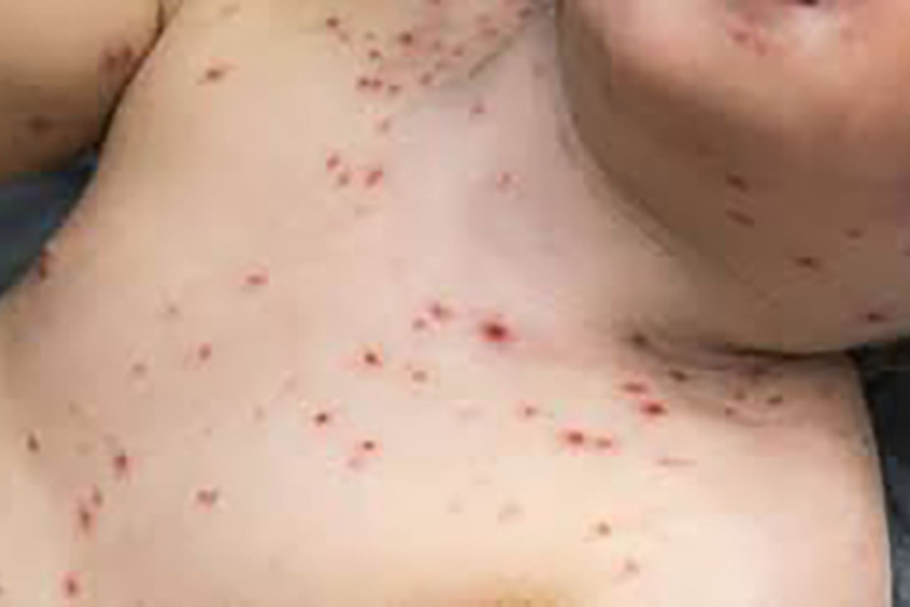 La rubéola es una enfermedad de transmisión viral contagiosa y caracterizada por la presencia de erupciones en la piel. Foto: INTERNET/Medios