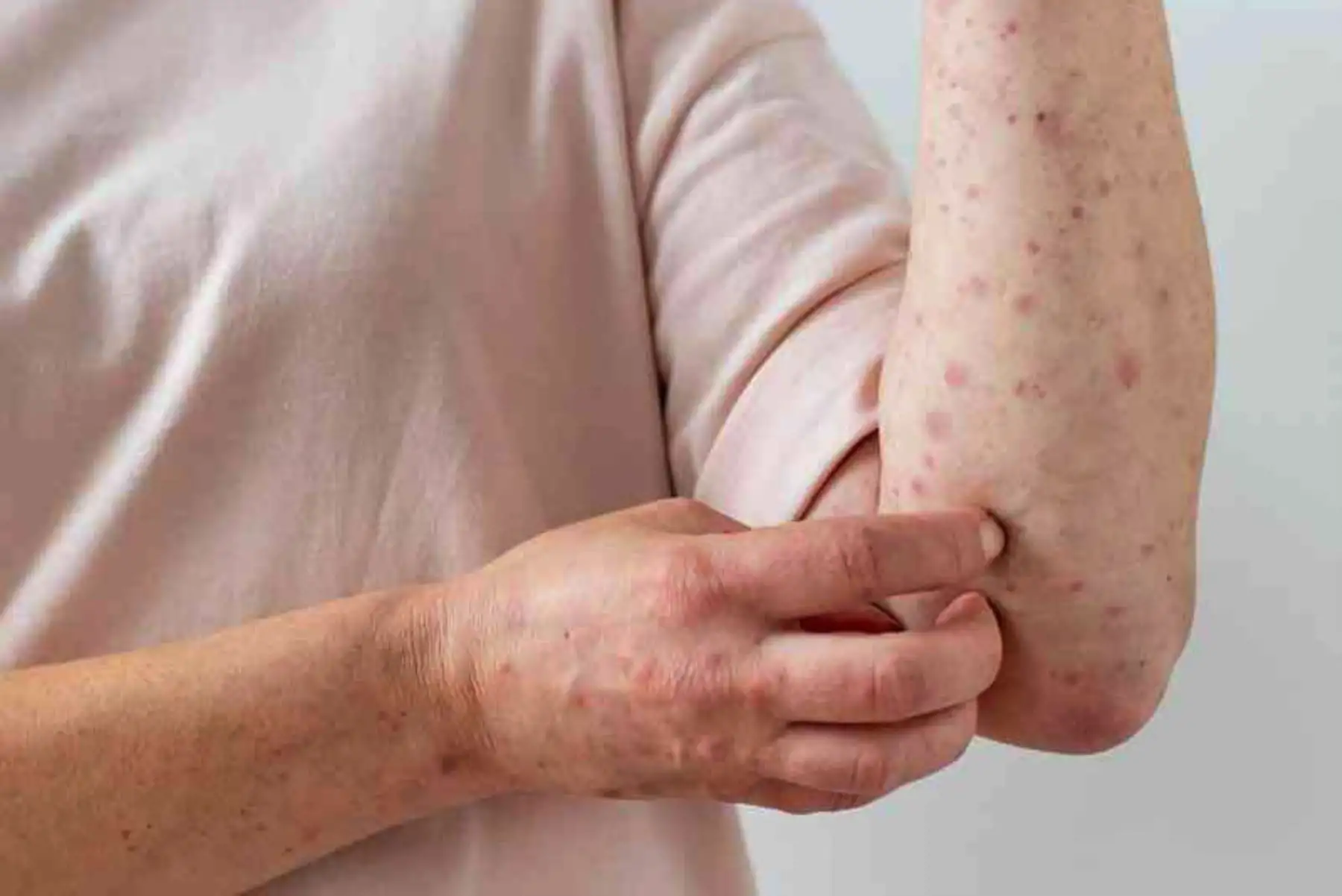 La viruela del mono puede aparecer como pústulas (granitos con puntitas de pus) o con lesiones grandes en la cara o diversas partes del cuerpo.  ANDINA/Difusión