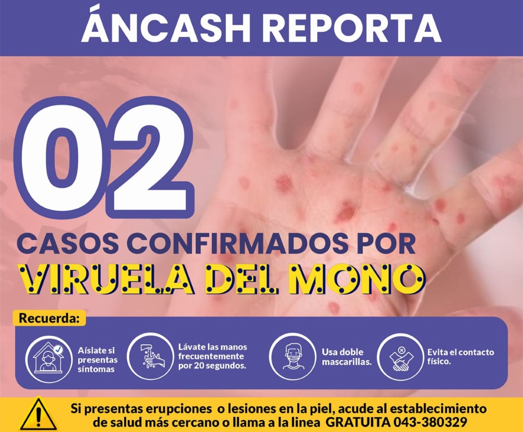 Diresa Áncash confirma dos casos de viruela del mono en la ciudad de Chimbote, provincia del Santa.