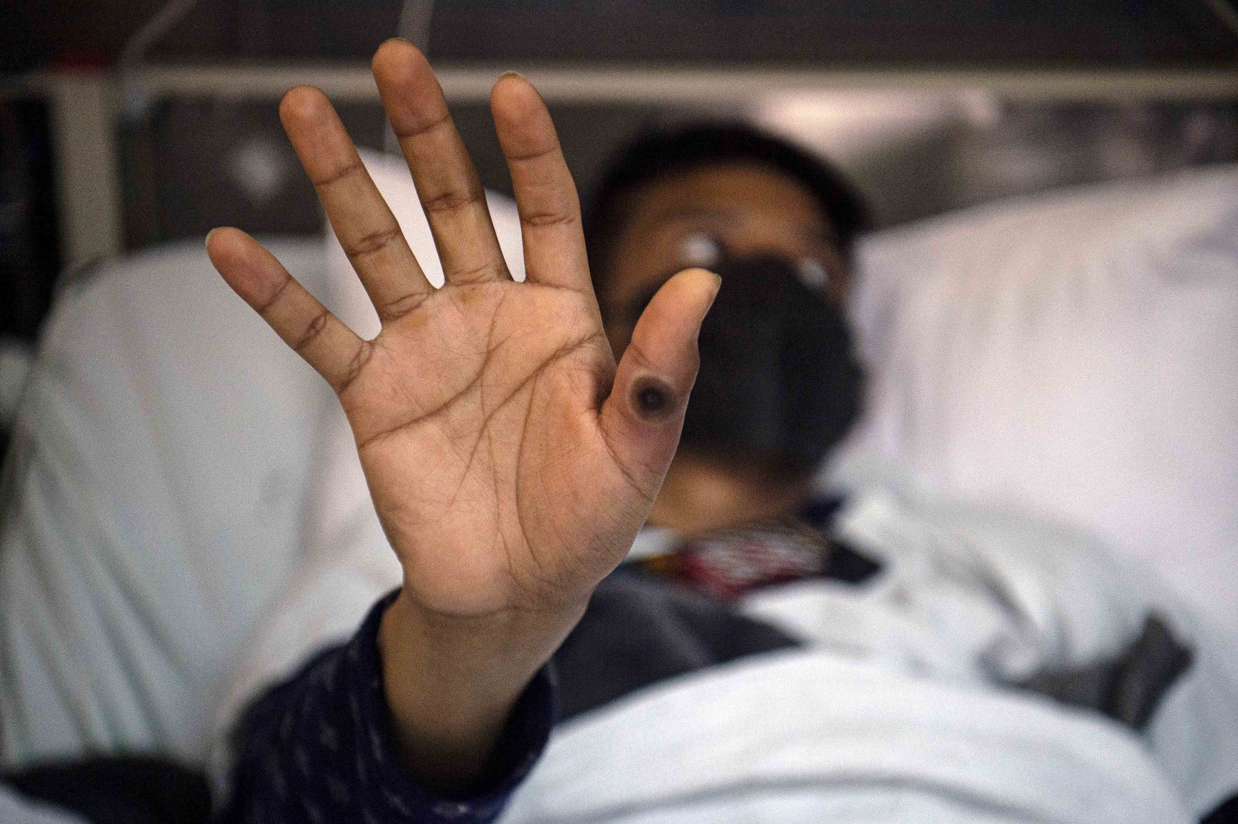 La OMS lo declaró emergencia de salud pública internacional el 23 de julio. Foto: AFP