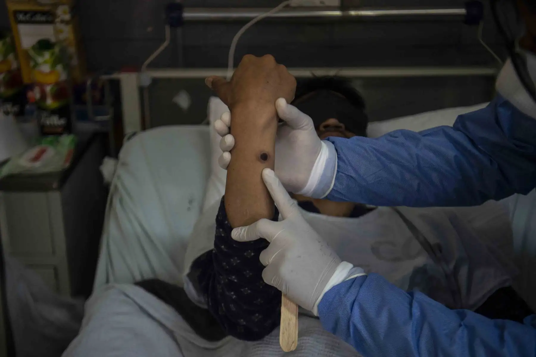 Dos elementos clave de la enfermedad: la fiebre, a veces acompañada de dolores musculares, y lesiones corporales, que se transforman en crostas. Foto: AFP