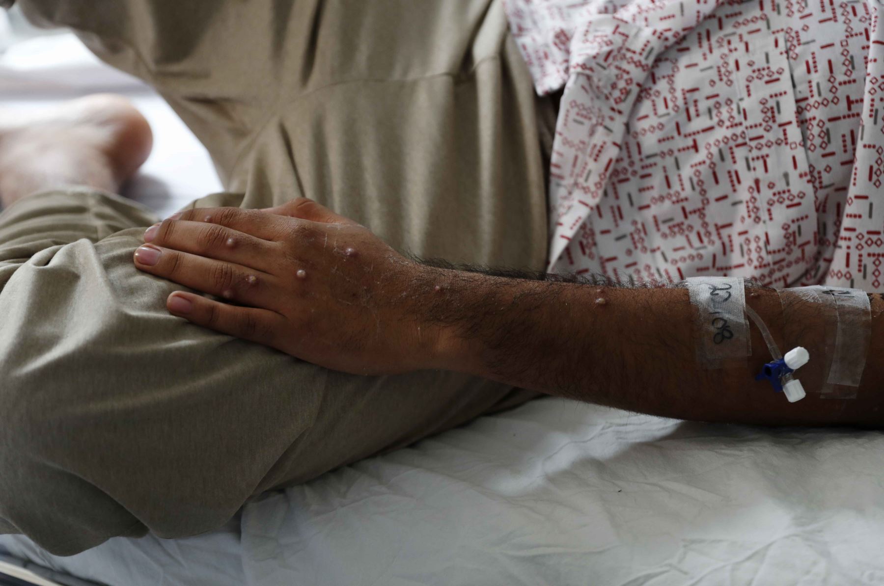 Un paciente es atendido tras ser diagnosticado con la viruela del mono, en el hospital Cayatano Heredia, en Lima. Foto: EFE