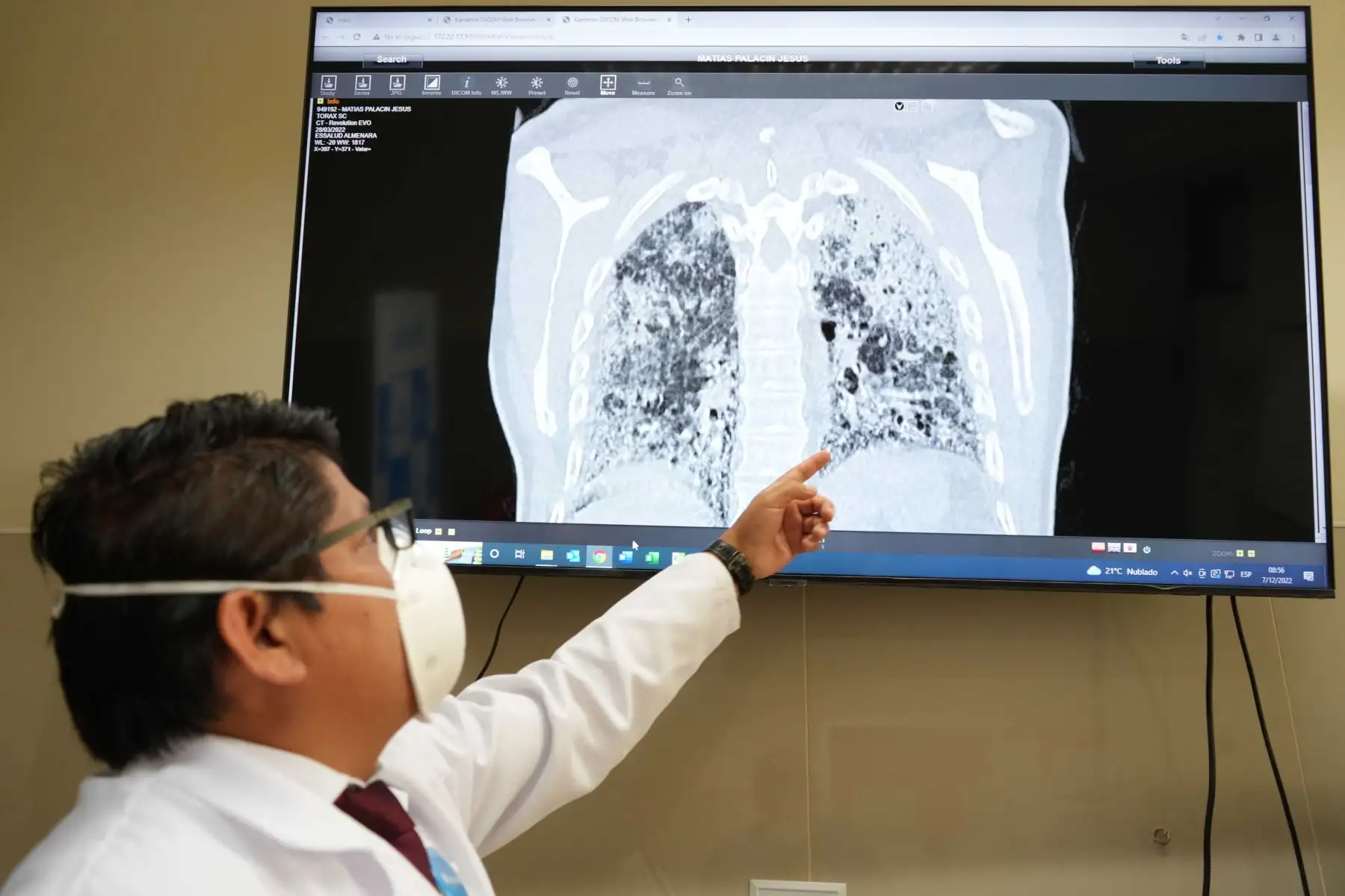Jesús Melquiades Matías Palacín (65) , nos relata que desde hace 2 años dejó de trabajar porque pasó a ser dependiente de oxígeno. De acuerdo a la biopsia su enfermedad era hereditario autoinmune, por lo que se sentía deprimido. “Durante toda la pandemia tenía tos, sentía que se ahogaba y por la edad que tengo había perdido toda esperanza para un trasplante”. Foto: EsSalud
