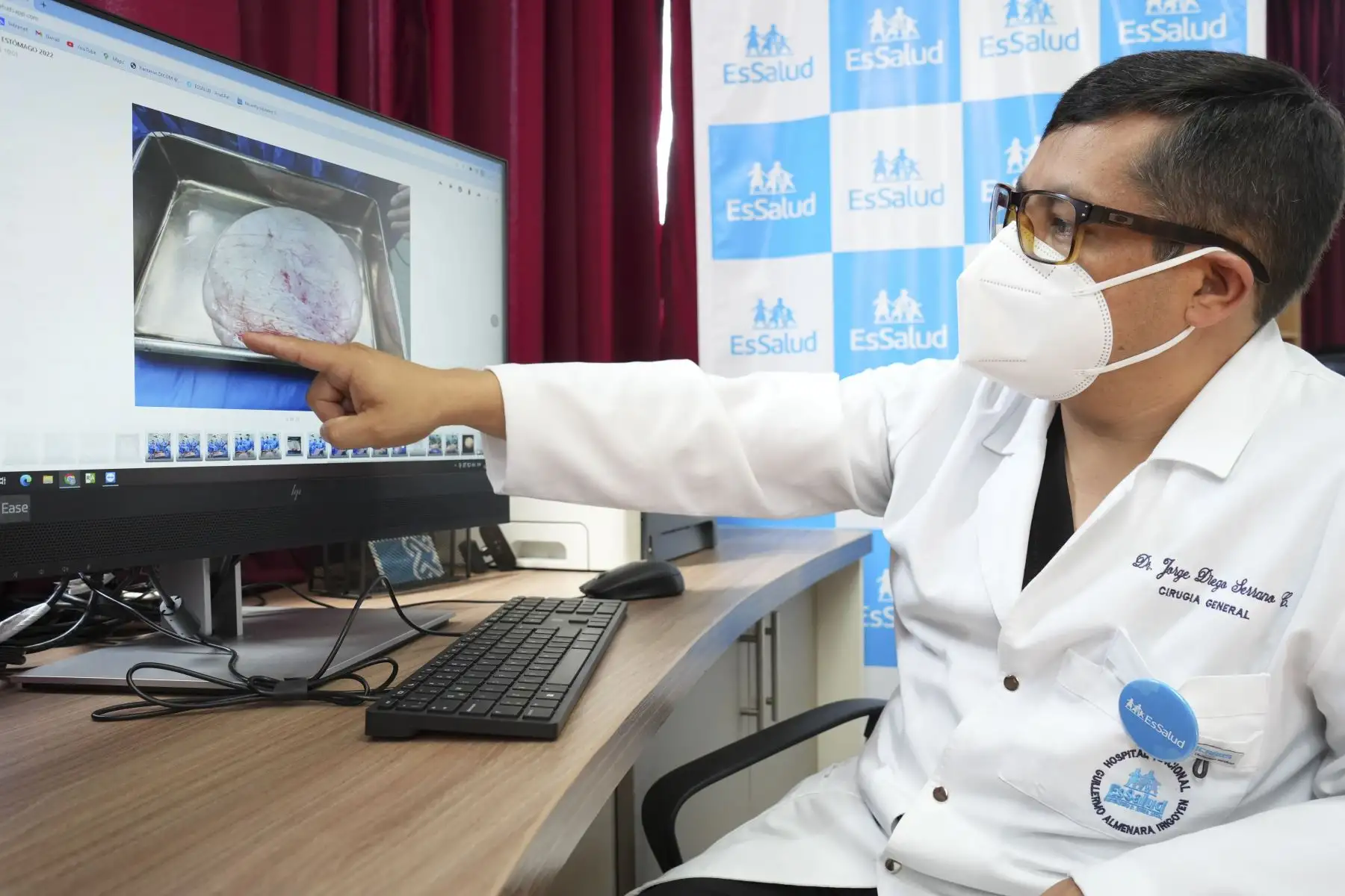 El Dr. Idelso Vásquez Llanos, jefe encargado del Servicio de Cirugía de Esófago y Estómago del Almenara, indicó que la compleja intervención duró tres horas y contó con la participación de un equipo multidisciplinario encabezado por el Dr. José Alarcón Vera.
Foto: ANDINA/EsSalud