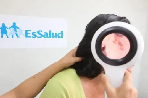 EsSalud reporta 1877 casos de melanoma y otros tumores de piel durante el 2022. Foto:ANDINA/Difusión