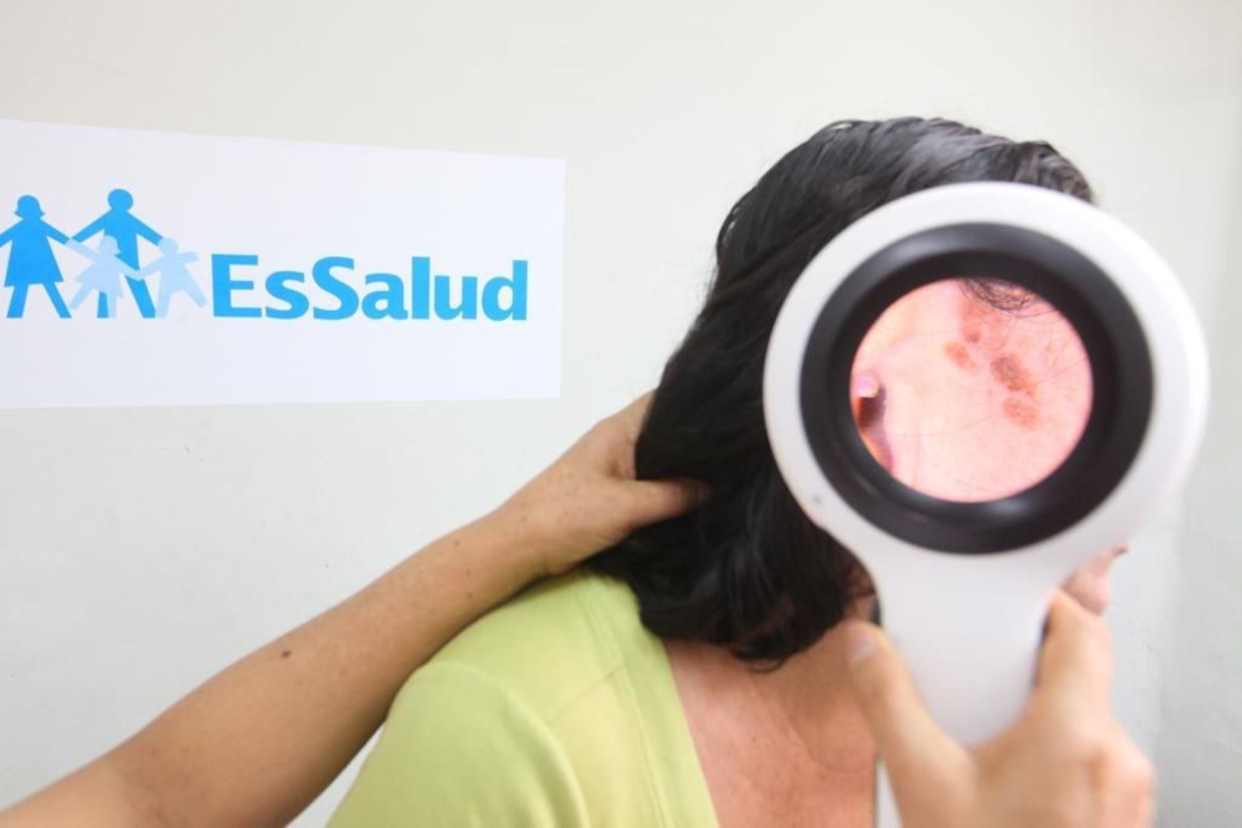 EsSalud reporta 1877 casos de melanoma y otros tumores de piel durante el 2022. Foto:ANDINA/Difusión