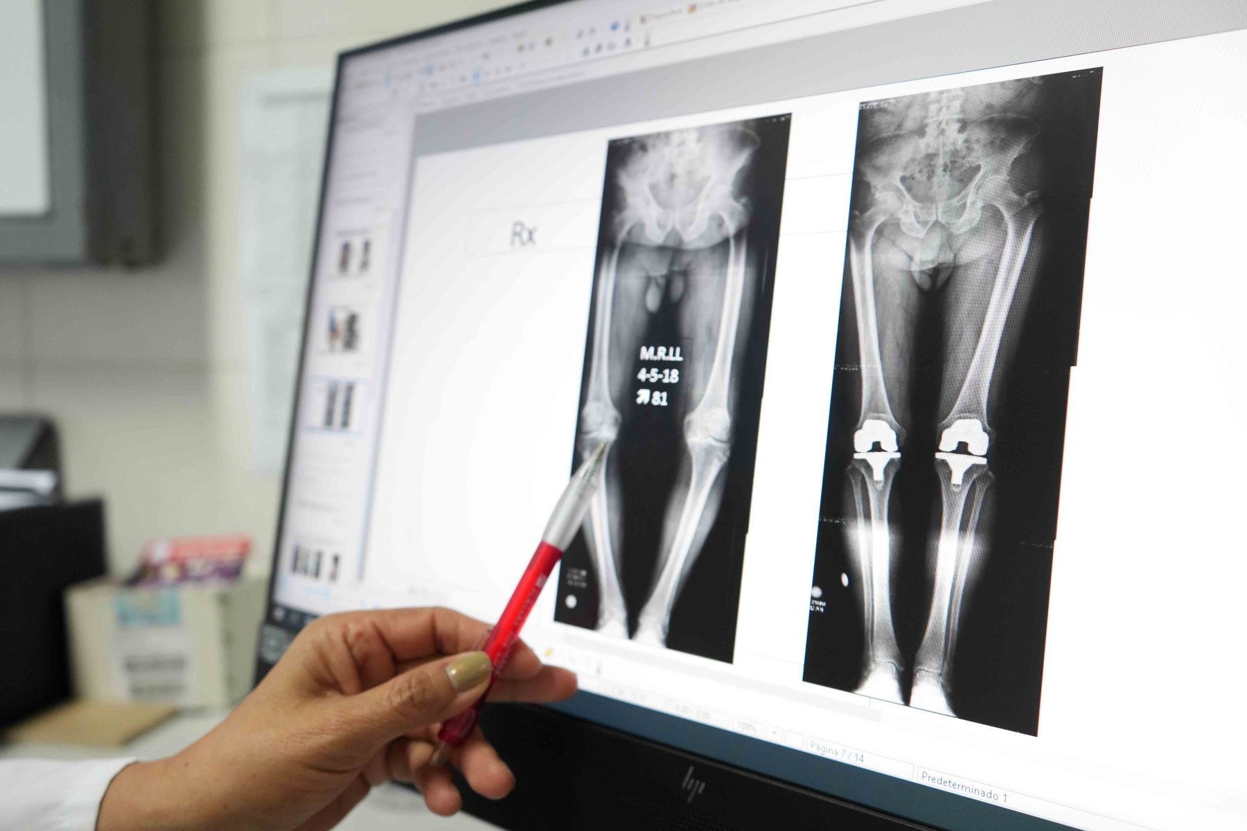 Traumatólogos del hospital Almenara reconstruyeron 210 rodillas en los últimos seis meses