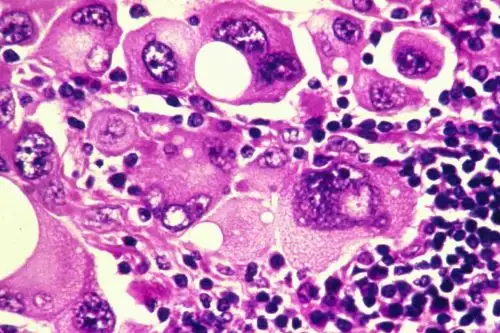 Se continuará investigando la combinación de la vacuna con la inmunoterapia para el tratamiento adyuvante de pacientes con estadio III/IV de melanoma de alto riesgo.