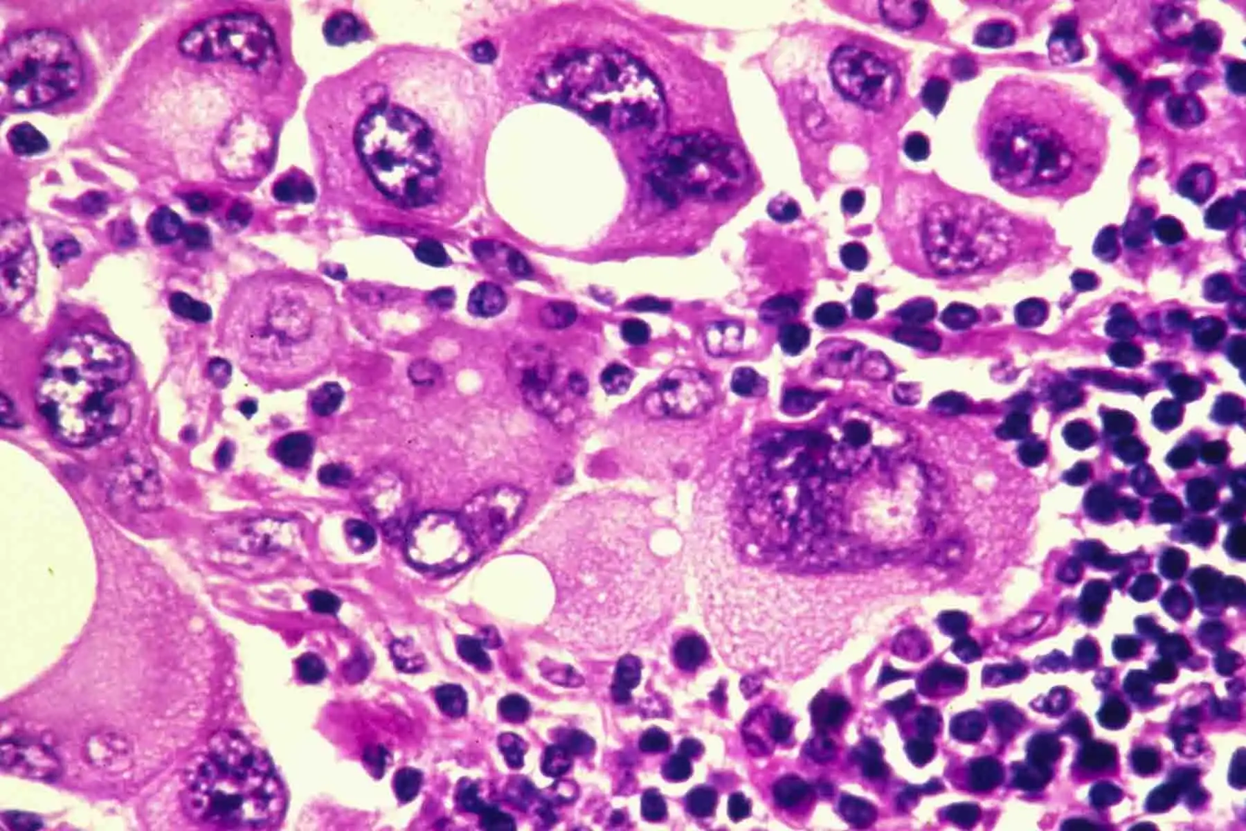 Se continuará investigando la combinación de la vacuna con la inmunoterapia para el tratamiento adyuvante de pacientes con estadio III/IV de melanoma de alto riesgo.