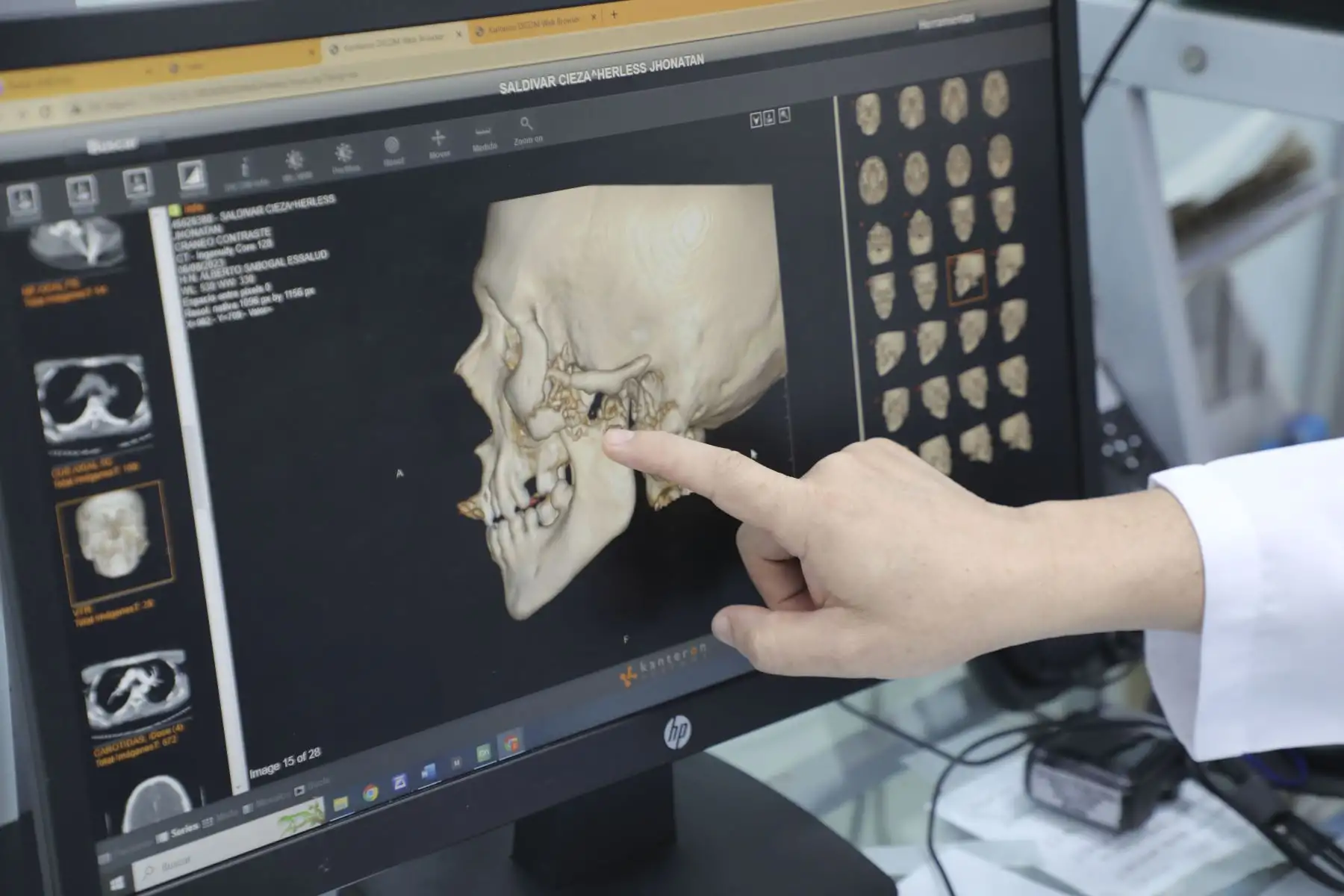 El Dr. Hiroshi Concha, cirujano odontológico que realizó la intervención maxilofacial, señaló que se hizo una limpieza quirúrgica y una reconstrucción primaria que permitieron la recuperación funcional y estética de la zona. Ahora queda pendiente una segunda intervención.
Foto: ANDINA/EsSalud