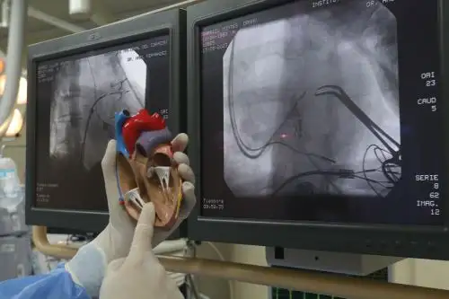 El paro cardiaco es la primera causa de muerte en el mundo y, en el caso peruano, ocupa el segundo lugar después de la neumonía. Su principal causa es el infarto cardiaco, informó el Dr. Rubén Azañero, cardiólogo del Hospital Nacional Dos de Mayo. Foto: ANDINA/Difusión