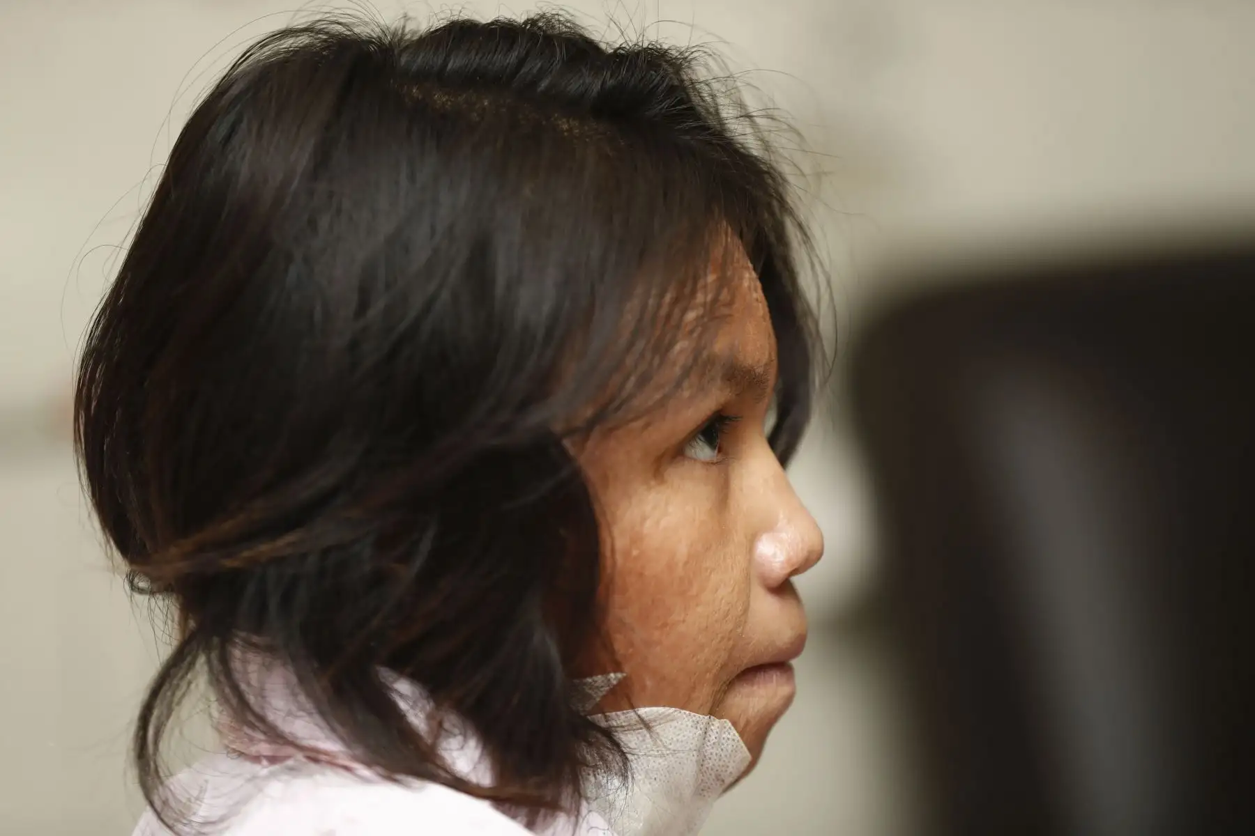 Roxana Ponero es una niña de 13 años natural de Ucayali, que en el 2021 sufrió un accidente que le provocó quemaduras en el 85% de su cuerpo. Tuvo la oportunidad de ser trasladada a Lima para ser atendida en el INSN San Borja, en donde fue internada, la operaron, y ahora se encuentra recuperada y con muchas ganas de seguir con su vida. Foto: ANDINA/Daniel Bracamonte