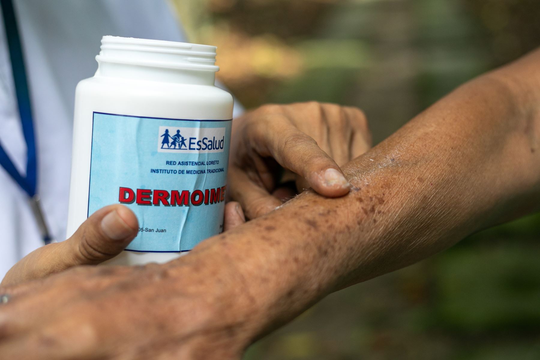 La pomada Dermoimet tiene efectos cicatrizantes y anti inflamatorios, y puede aplicarse para aliviar psoriasis en estado inicial, por ejemplo. ANDINA/ IMET.