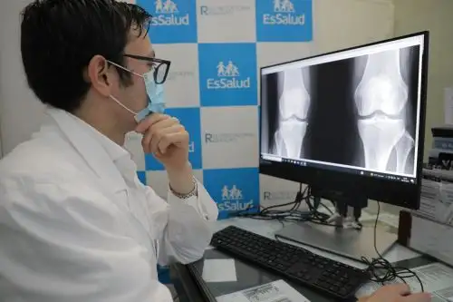 ¡Cuidado! Dolor matutino de articulaciones y rigidez puede deberse a artritis reumatoide. Foto: ANDINA/Difusión.