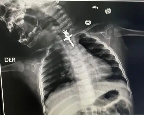 Médicos especialistas del hospital Víctor Lazarte Echegaray, de EsSalud, en Trujillo, lograron extraer con éxito un crucifijo que tenía en su esófago una bebé de 10 meses de nacida. Foto: ANDINA/difusión.