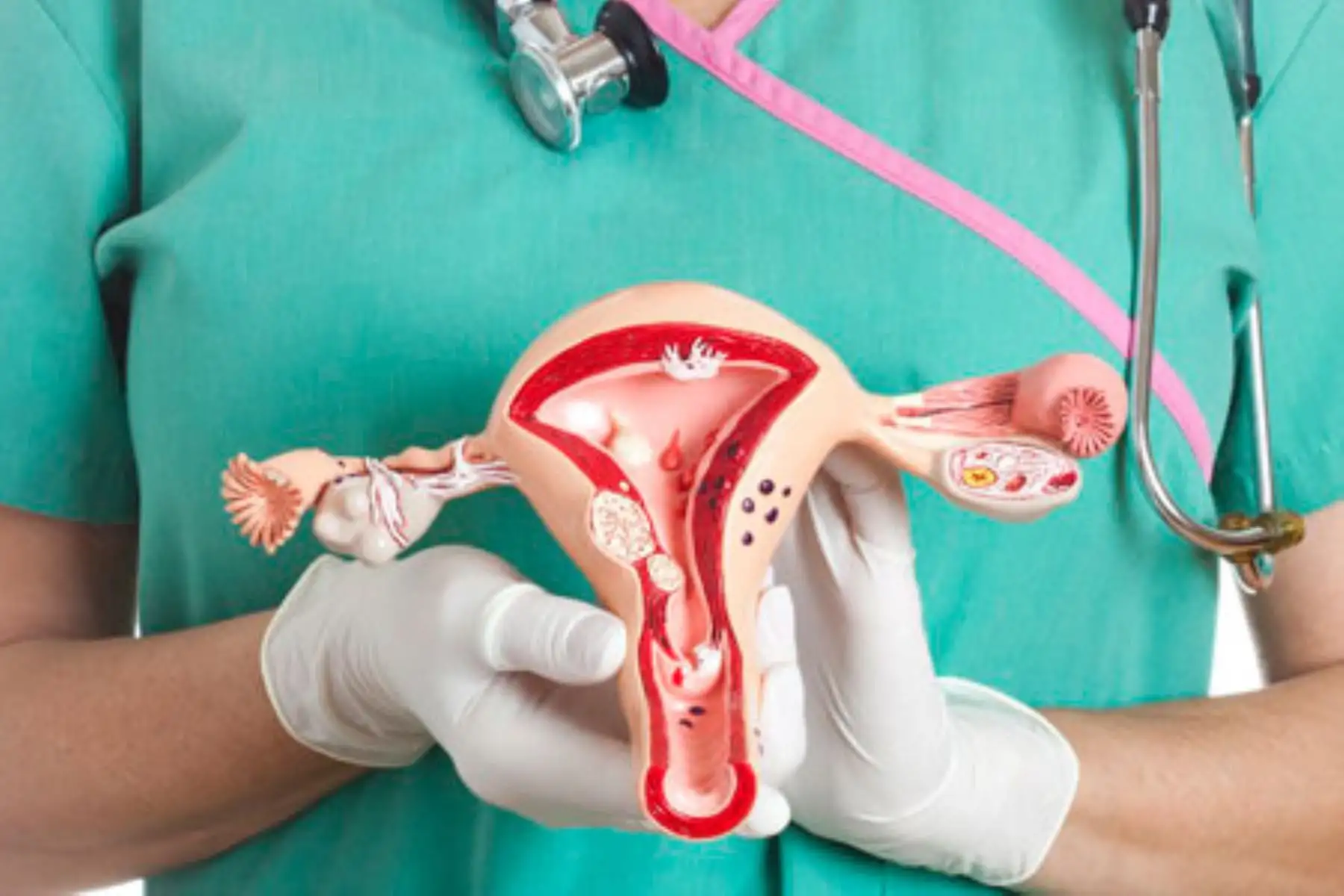 Síndrome de ovario poliquístico o SOP puede derivar en diabetes y problemas de fertilidad