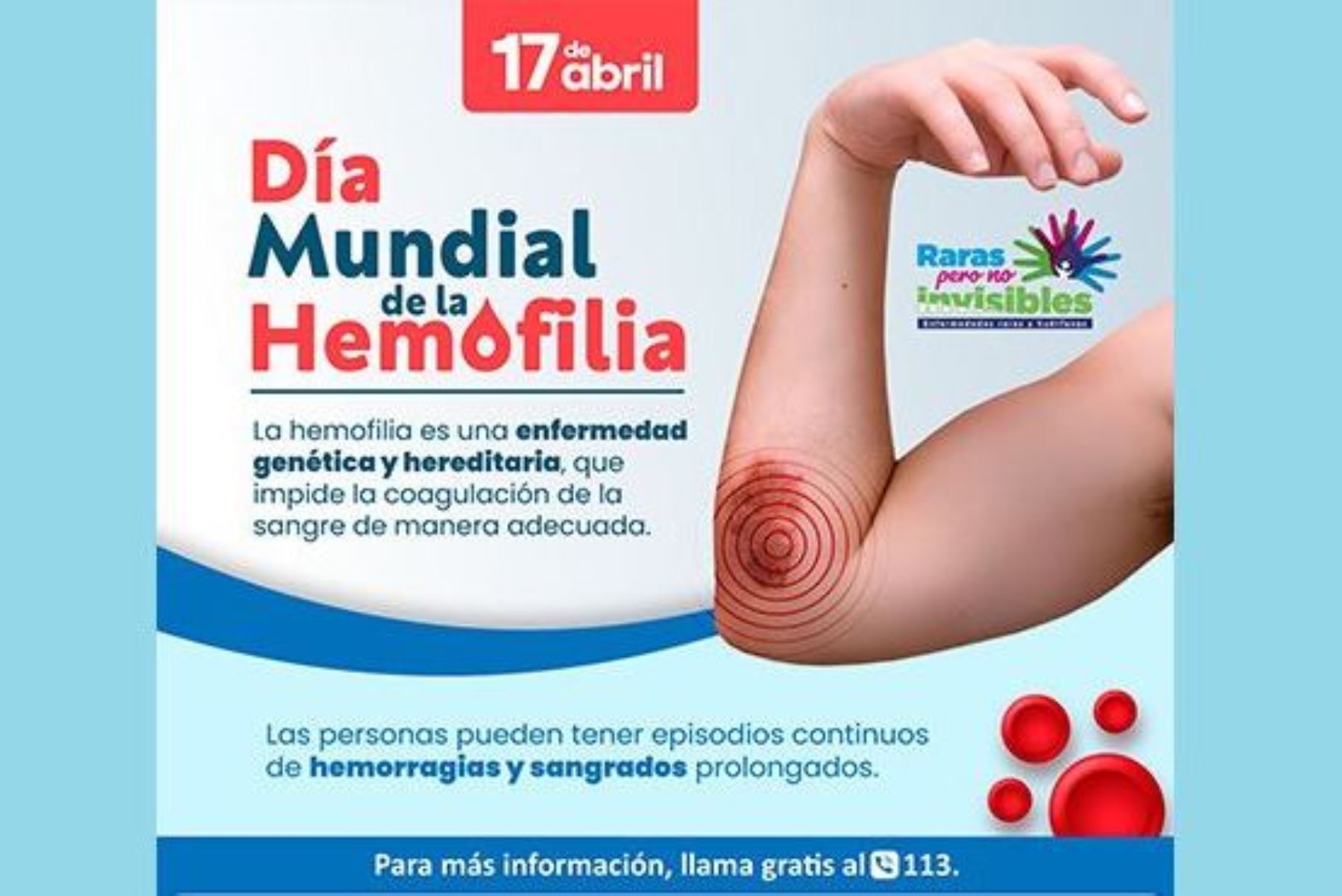 Día Mundial de la Hemofilia: aproximadamente 3,400 peruanos sufren de esta enfermedad. Foto: ANDINA/Difusión.