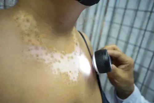 Los pacientes recibieron tratamientos con rayos ultravioleta B (UVB) de banda estrecha, con una frecuencia de 2 a 3 veces por semana. ANDINA/ EsSalud.