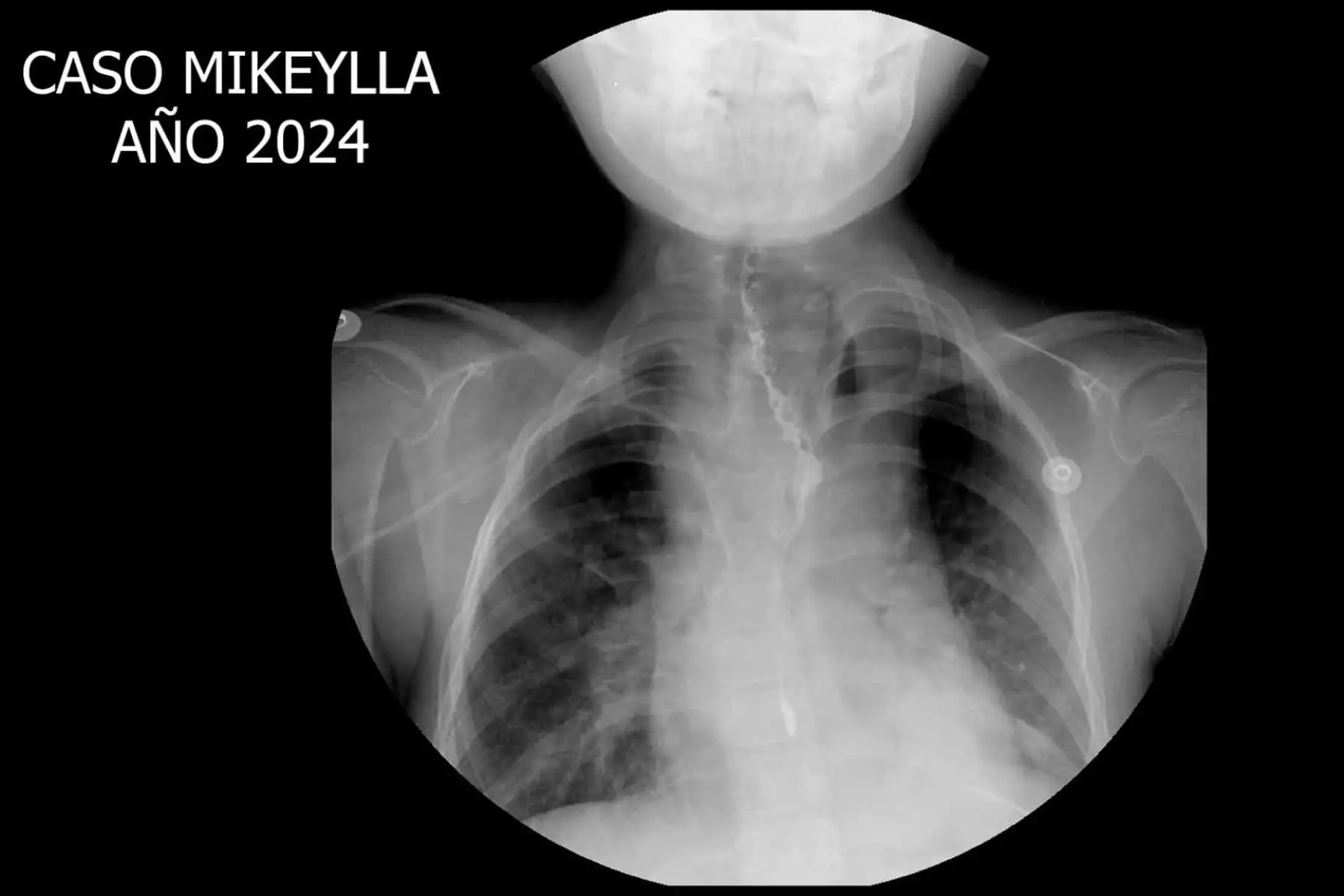 ikeylla nació con un diagnóstico severo de atresia esofágica, una malformación que afecta a 1 de cada 3 mil 500 recién nacidos vivos, y que le impedía incluso tomar leche materna. Foto: ANDINA/ EsSalud