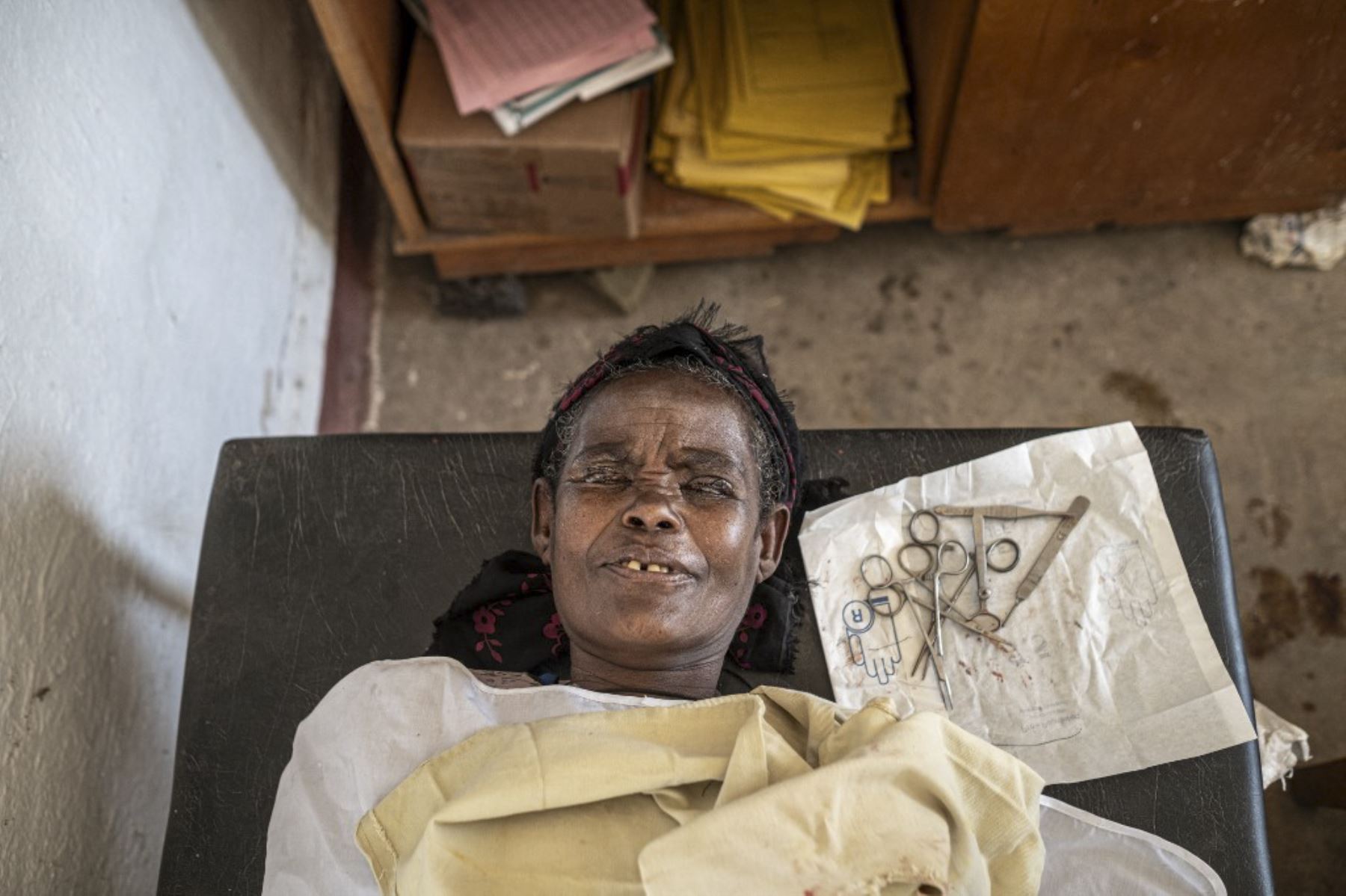 Tadelech Habtew descansa unos minutos en una cama después de someterse a una cirugía de tarsotomía para tratar el daño causado por una etapa avanzada de tracoma en un centro médico en un pueblo cerca de Butajira. El tracoma es responsable de cegar o deteriorar visualmente a casi dos millones de personas en todo el mundo. Es causada por la infección con la bacteria Chlamydia trachomatis, que se propaga a través del contacto con los ojos o la nariz de las personas infectadas. Foto: AFP