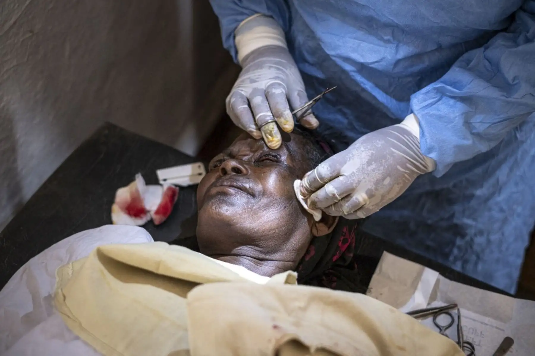 El paciente de tracoma Tadelech Habtew se somete a un procedimiento ocular en un centro médico en un pueblo cerca de Butajira. El tracoma es responsable de cegar o deteriorar visualmente a casi dos millones de personas en todo el mundo. Es causada por la infección con la bacteria Chlamydia trachomatis, que se propaga a través del contacto con los ojos o la nariz de las personas infectadas. Foto: AFP