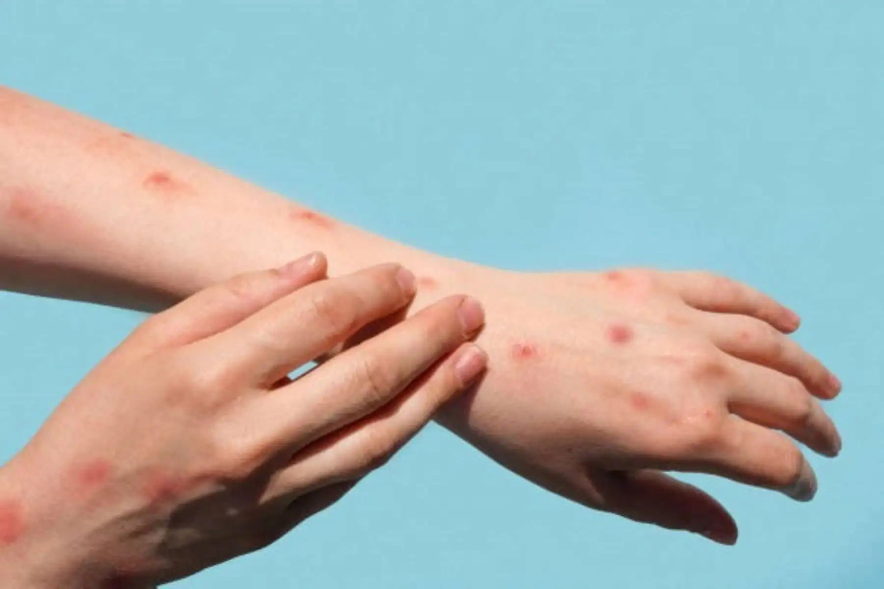 La Mpox, antes conocida como viruela del mono, es una enfermedad viral causada por el virus "Orthopoxvirus". Se caracteriza por la aparición de erupciones en la piel.