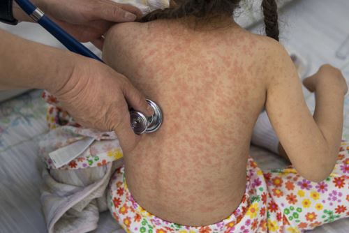 El número de casos de sarampión en México va en aumento (imagen referencial). Foto: INTERNET/Medios