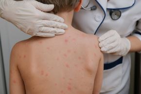 La vacuna contra el sarampión se encuentra disponible en todos los establecimientos de salud del país, informa el Minsa. Foto: Internet/Medios