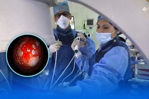 Implementan técnicas innovadoras para el diagnóstico temprano de cáncer de pulmón. Foto: ANDINA/Difusión.