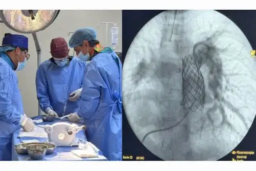 Cardiólogo argentino y equipo de médicos del INSN colocan implante de válvula pulmonar a pacientes con cardiopatía congénita. Foto: Difusión