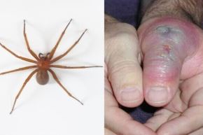 INS advierte aumento de mordeduras de araña casera durante el invierno. Foto: ANDINA/Difusión.