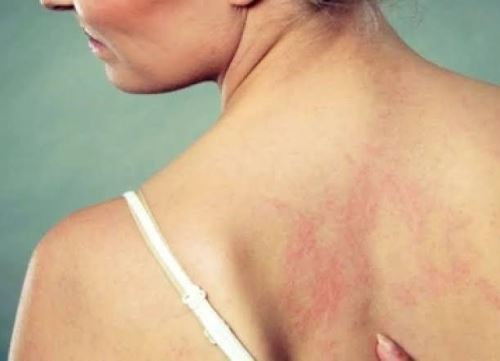 La Dirección Regional de Salud de Piura puso en marcha medidas de vigilancia epidemiológica ante el primer caso de lepra reportado en dicha región. ANDINA/Difusión