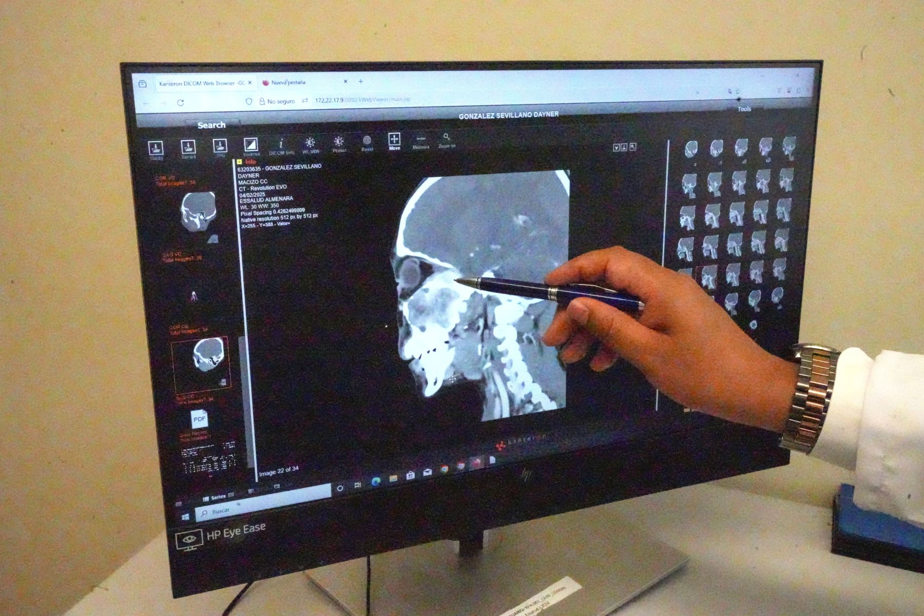“El tumor comprometía los senos paranasales, invadía el tercio medio del cerebro y ponía en riesgo su visión. Se trataba de un nasoangiofibroma, una enfermedad congénita rara. Por la urgencia del caso, decidimos programar la cirugía”, explicó el doctor Marco Antonio Rozan Flores, cirujano máxilo-facial especializado en cabeza y cuello.ANDINA/Difusión