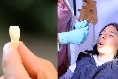 Salud bucal: ¿Se puede reimplantar el diente de un niño? Foto: ANDINA/Difusión.