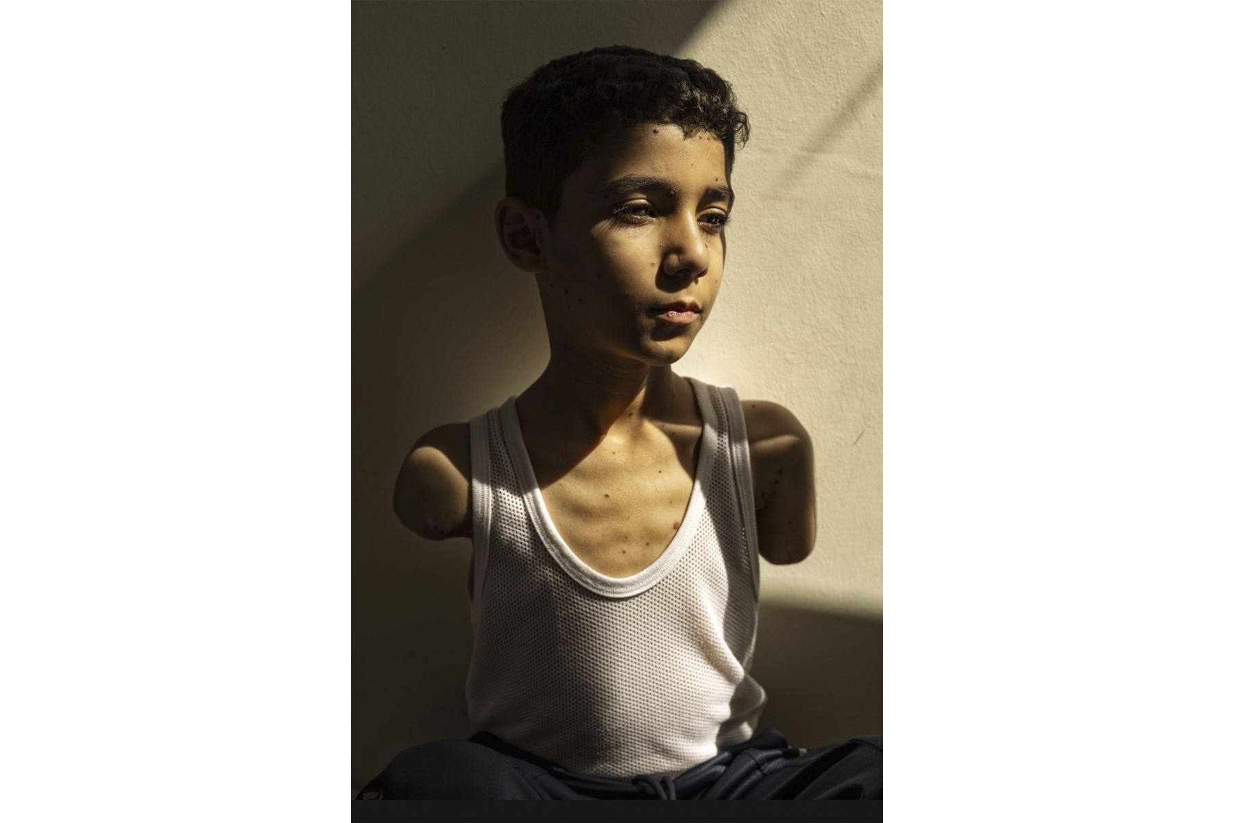 28 de junio de 2024
Mahmoud Ajjour (9), quien resultó herido durante un ataque israelí en la ciudad de Gaza en marzo de 2024, encuentra refugio y asistencia médica en Doha, Catar. Foto: Word Press Photo (Samar Abu Elouf)